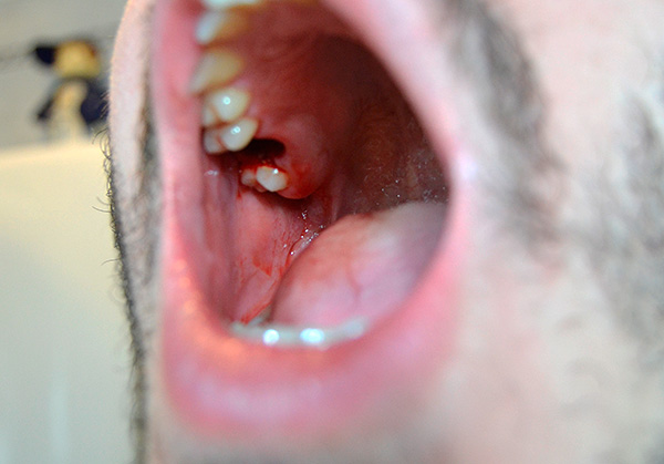 Χρησιμοποιώντας μια σειρά τεχνικών, είναι δυνατό να μειωθεί σημαντικά οίδημα των ιστών μετά από την εξόρυξη δοντιών ...