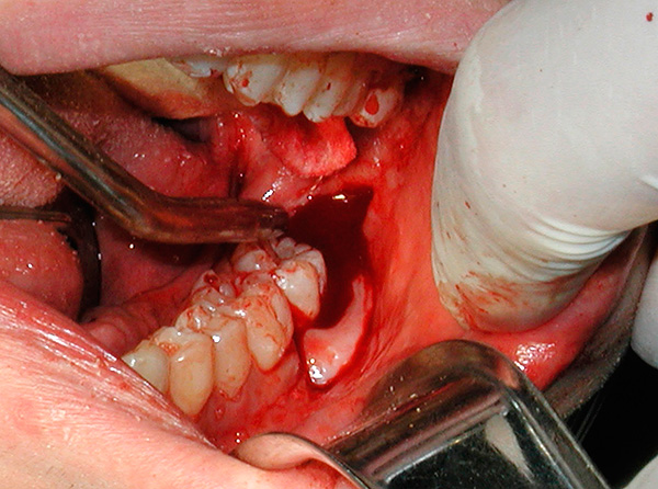 Con el aumento de la presión arterial, existe un alto riesgo de desarrollar edema severo después de la extracción del diente (a menudo, también se observa sangrado prolongado del orificio).