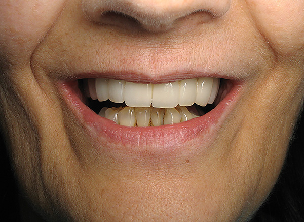 Les pròtesis amb tancament permet no només tornar la capacitat de mastegar menjar normalment, sinó també aconseguir un bonic somriure.