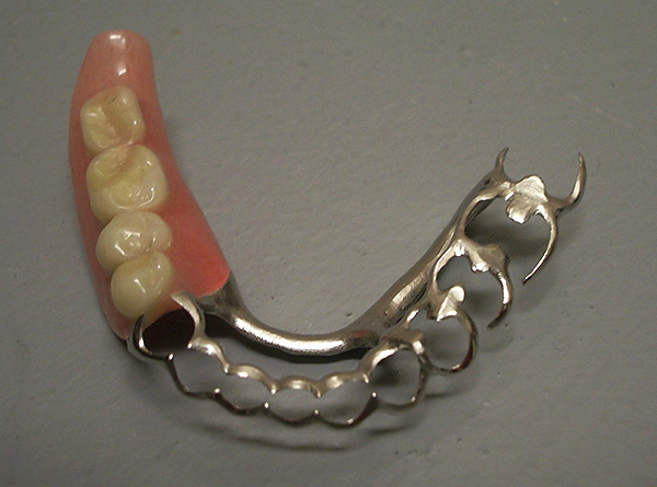 Kai kuriais atvejais atliekant protezų užsegimą, paciento mobilieji dantys gali būti apsaugoti nuo pašalinimo dėl struktūros suskaidymo.