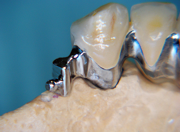 Part of the micro-lock is attached to the crown, which is worn on the abutment.