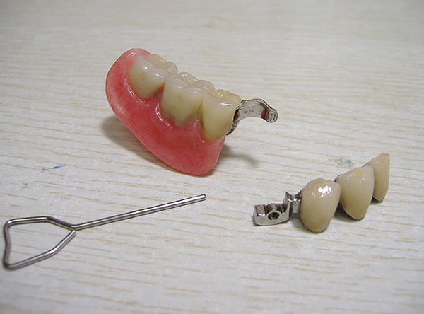 Les prothèses dentaires sur les attachements se caractérisent par une esthétique améliorée, une facilité de port et une fixation fiable dans la cavité buccale.