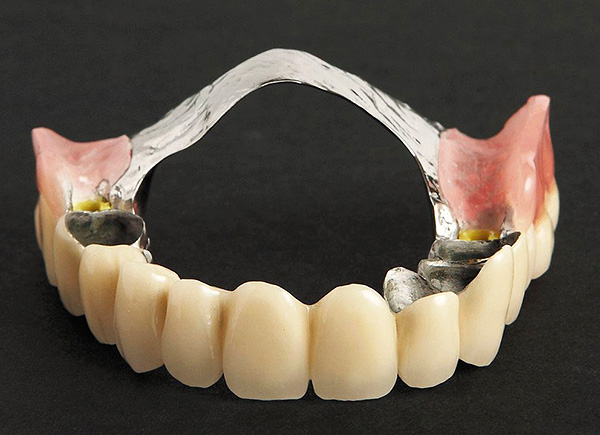 Clasp prosthesis on the so-called telescopic crowns.