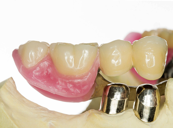 Коронките на подвижната част на протезата се поставят върху коронки, монтирани на опорните зъби.