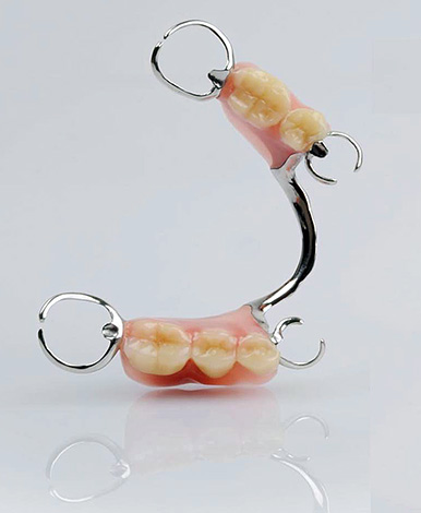 Clasp prosthesis with fastening on hooks (clasps)