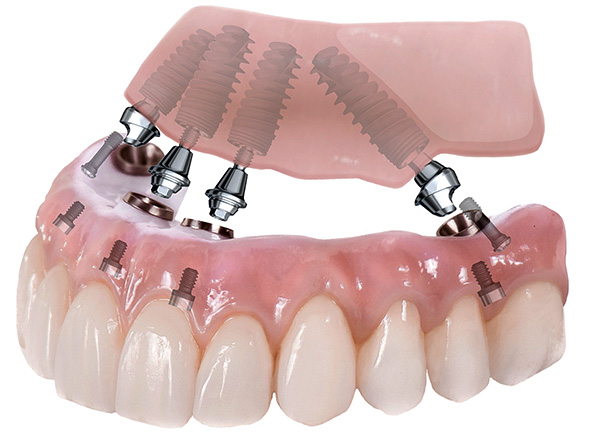 Das Bild zeigt das Schema der Zahnprothetik mit All-on-4-Technologie.