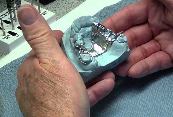Protesi di aggancio del pezzo su un modello in gesso della mascella.