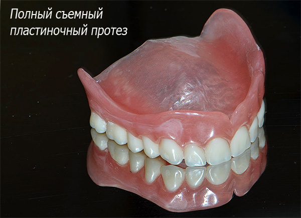 Fotot visar en komplett avtagbar laminär protes - det hålls i munhålan genom att suga till tandköttet och gommen.