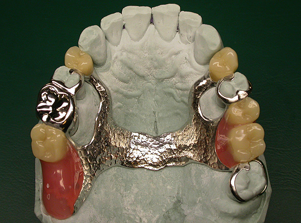 Ang clasp prosthesis ay nakadikit sa oral cavity na mas maaasahan at mas malakas kaysa sa lamellar.