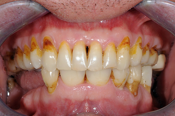 Muligheten for pålitelig festing av låseprotesen bestemmes i stor grad av tilstanden til pasientens munnhule.