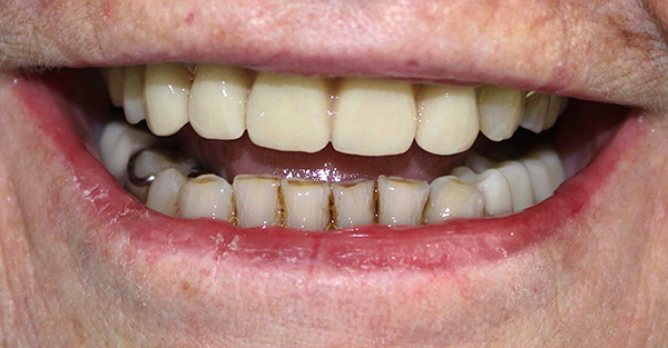 The result of prosthetics using partial acrylic dentures ...