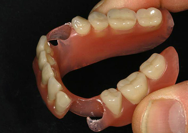 Kai burnoje trūksta dantų, nailono protezas bus ne pats geriausias protezavimo būdas ...