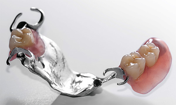 Die einfachste Option für eine herausnehmbare Verschlussprothese ist eine Struktur, die mit Metallhaken (Verschlüssen) an den Zähnen befestigt ist.