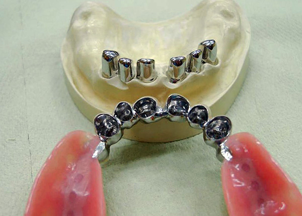 Clasp prosthesis with fixation on telescopic crowns.