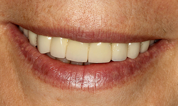Gigi gigi berkualiti tinggi boleh mengembalikan fungsi mengunyah dan keindahan senyuman.