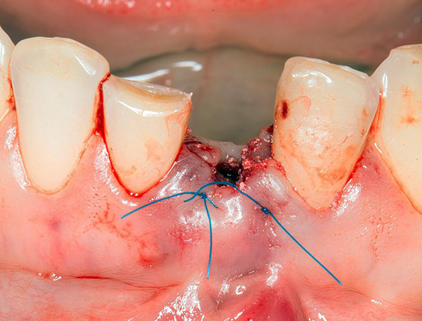 Gigi palsu segera digunakan untuk memulihkan estetika serta-merta selepas pengekstrakan gigi.