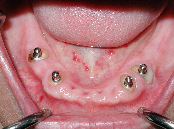 Implantes intracanales para la fijación de la dentadura.