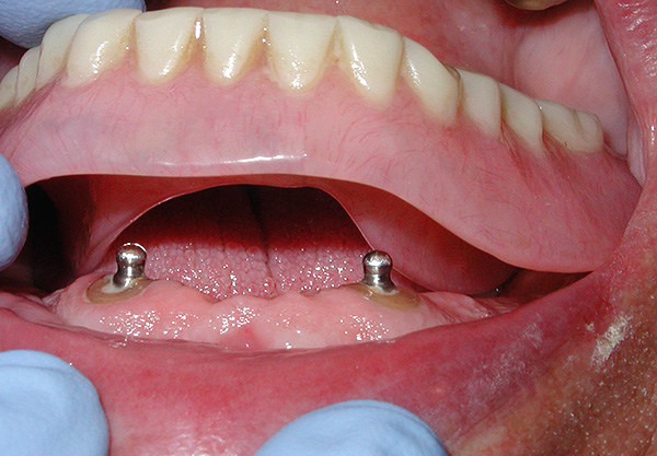Thanks to the intra-channel implants, the prosthesis is attached very securely and a high esthetics can be achieved.