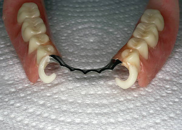 تعتمد تكلفة طقم الأسنان القابل للإزالة على عوامل عديدة ...