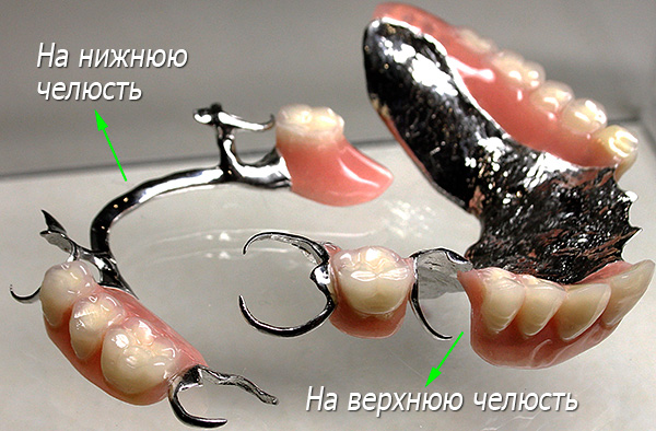 Cierre de dentaduras postizas en la mandíbula superior e inferior con fijación en los cierres.