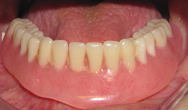 Το αποτέλεσμα της προσθετικής χρησιμοποιώντας μια πλήρη οδοντοστοιχία ...