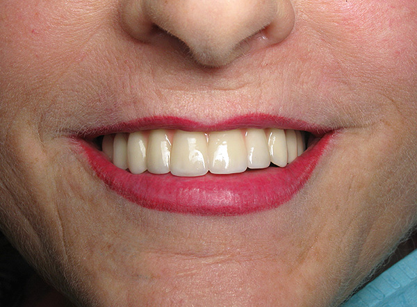 ภาพถ่ายแสดงผลของการทำฟันเทียมโดยใช้ฟันปลอมแบบถอดได้แบบมีเงื่อนไขบนรากฟันเทียม
