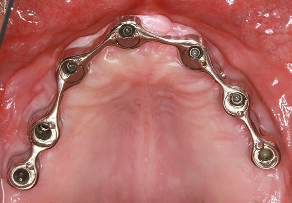 Metalna greda kombinira ugrađene implantate u jednu cjelinu.