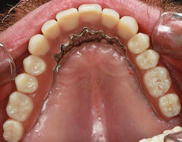 Στη συνέχεια, μια συζευκτική οδοντοστοιχία που είναι αφαιρούμενη εξαρτάται από τη δέσμη.