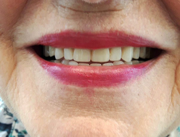 Gambar menunjukkan hasil prostetik menggunakan gigi palsu penuh (kedua-dua rahang atas dan bawah).