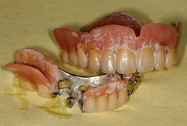 The photo shows what happens with a denture if you do not take care of it ...
