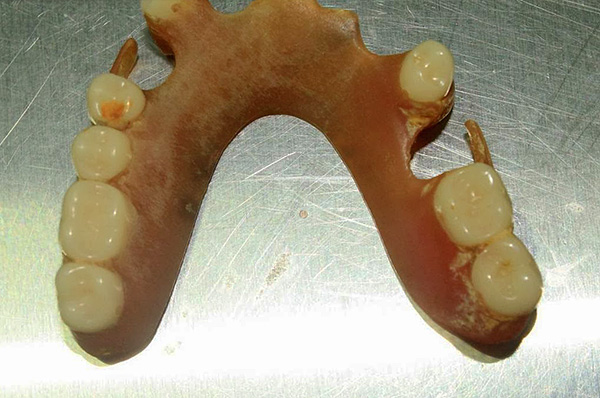 คราบแบคทีเรียที่ก่อตัวขึ้นบนฟันปลอมใด ๆ จึงเป็นสิ่งสำคัญในการทำความสะอาดอย่างสม่ำเสมอ