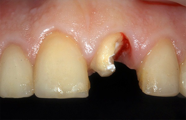 Kes klinikal: gigi depan pecah kerana kecederaan mekanikal.