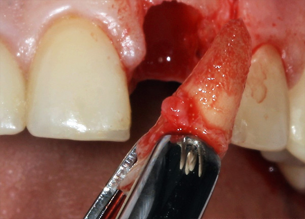In order to carry out immediate implantation, the tooth root should be removed as accurately as possible, without damaging the bone walls of the hole.