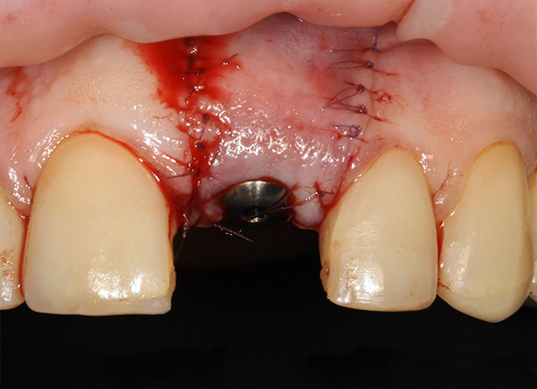 Appearance immediately after installation of the Snukon implant and suturing.