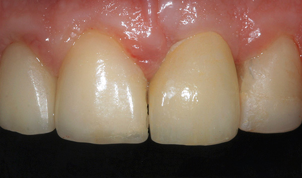En helkeramisk krone er installert på distansen - i utseende er den nesten ikke skille fra den innfødte tannen.