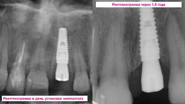 Röntgenohjaus - kuvat heti implantin asettamisen jälkeen ja 1,5 vuoden kuluttua.