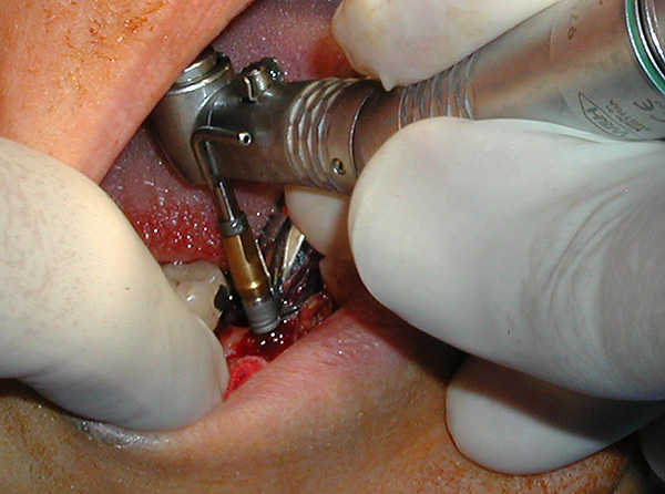 The more thoroughly the implantation system is thought out, the better for both the patient and the implantologist.
