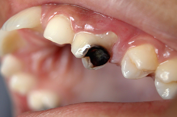Il costo del trattamento di un dente distrutto dalla carie è immediatamente influenzato da molti fattori, che continueremo a considerare ...