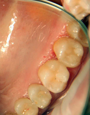 Una persona sense formació està lluny de poder sempre identificar quina dent requereix tractament: un metge que no estigui net a mà pot aprofitar-ho.