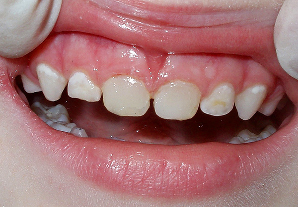 Un exemple de caries initiales dans les dents de bébé d'un bébé.