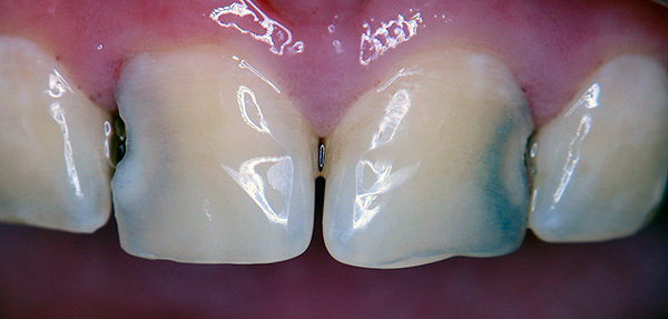 Spesso è tra i denti che il cibo non viene completamente ripulito - qui inizia lo sviluppo della carie.