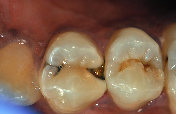 Le coût d'un joint installé sur une dent après sa préparation peut varier considérablement.