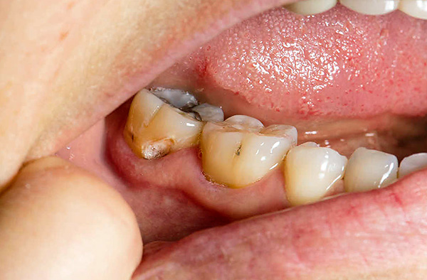 Si la dent n'est pas traitée à temps, le processus carieux dans la zone cervicale ne fera que progresser.