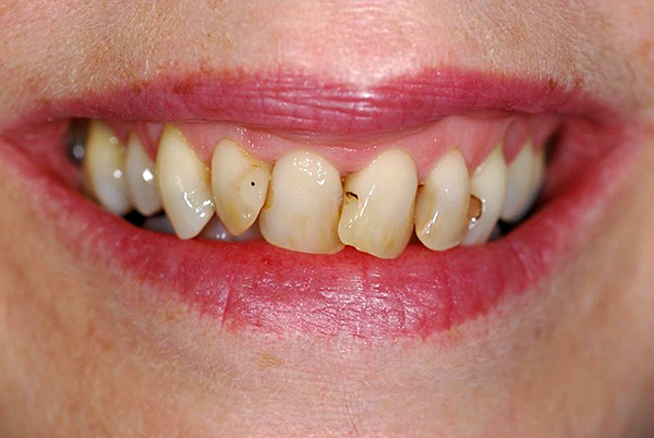 El cost del tractament de les dents anteriors, per regla general, és sensiblement més gran, ja que hi ha requisits augmentats d’estètica.