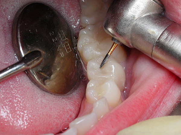 El taladro sigue siendo una de las herramientas principales en el arsenal de un dentista.