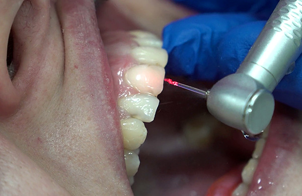 The photograph shows the preparation of the front tooth with a dental laser.