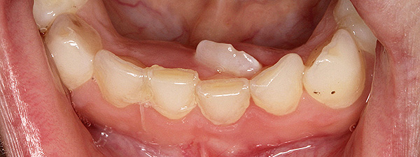 Bir çocukta yüzeysel diş