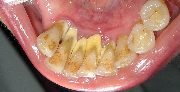 Fotoğraf, ağız hijyeninin yetersiz düzeyde olduğu dişlerin durumunun tipik bir örneğini göstermektedir.