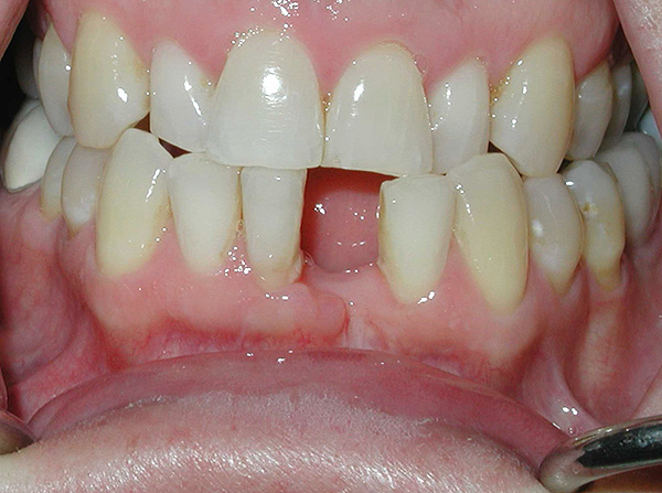 La situación antes del tratamiento: no hay diente frontal desde la parte inferior.