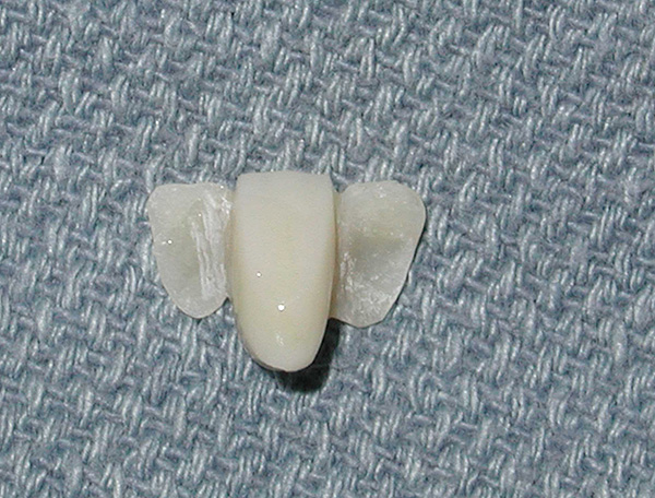 The prosthesis mempunyai plat khas di sisi yang akan terpaku pada gigi berlubang.